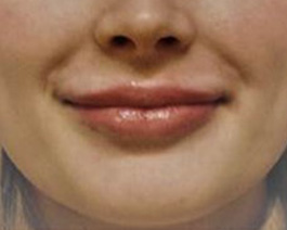 Lip Enhancement Before and After | Dr. Thomas Hubbard