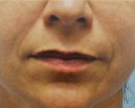 Lip Enhancement Before and After | Dr. Thomas Hubbard