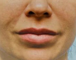 Lip Enhancement Before and After | Dr. Thomas Hubbard