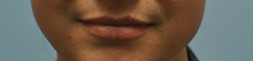 Lip Enhancement Before and After | Dr. Thomas Hubbard