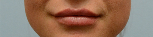 Lip Enhancement Before and After | Dr. Thomas Hubbard