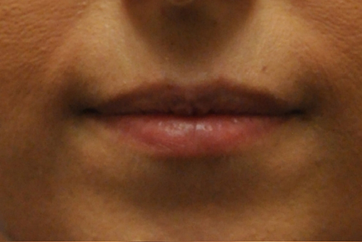 Lip Enhancement Before and After | Dr. Thomas Hubbard