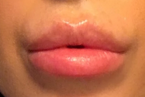 Lip Enhancement Before and After | Dr. Thomas Hubbard