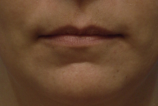 Lip Enhancement Before and After | Dr. Thomas Hubbard