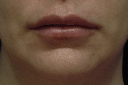 Lip Enhancement Before and After | Dr. Thomas Hubbard