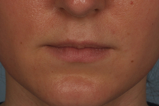 Lip Enhancement Before and After | Dr. Thomas Hubbard