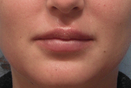 Lip Enhancement Before and After | Dr. Thomas Hubbard