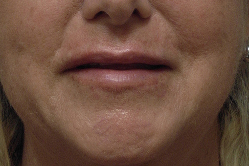 Lip Enhancement Before and After | Dr. Thomas Hubbard