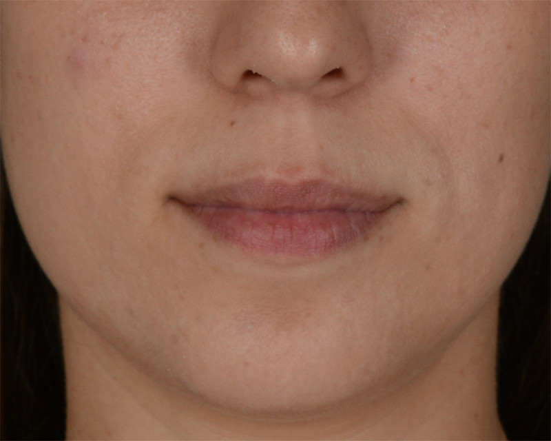 Lip Enhancement Before and After | Dr. Thomas Hubbard