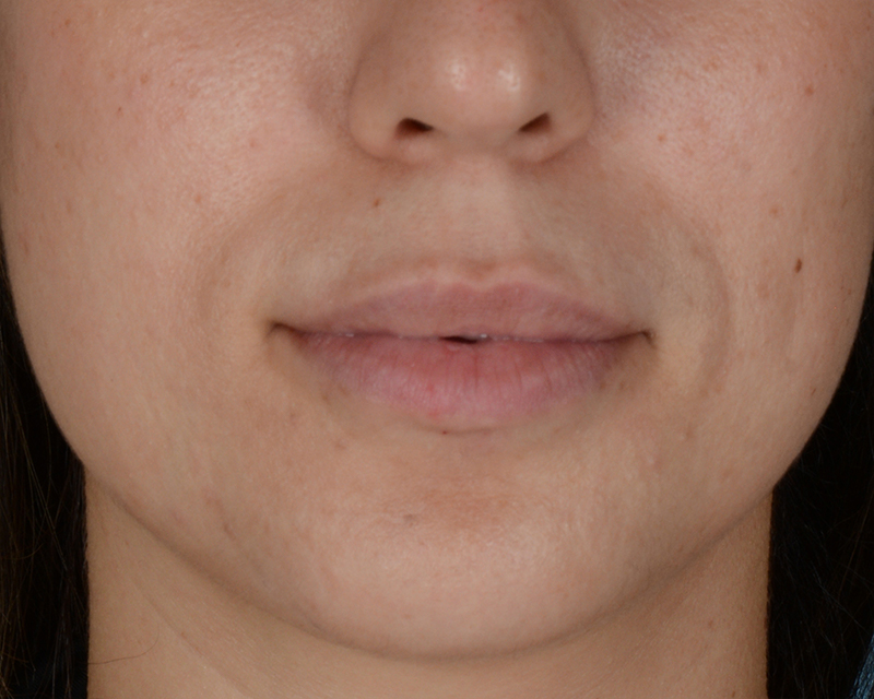 Lip Enhancement Before and After | Dr. Thomas Hubbard