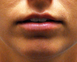 Lip Enlargement in Virginia Beach from Hubbard Plastic Surgery