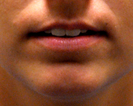 Lip Enlargement in Virginia Beach from Hubbard Plastic Surgery