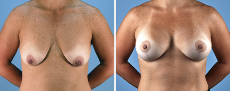 Breast Augmentation with Lift Virginia Beach