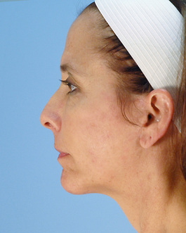 Facial Implants in Virginia Beach
