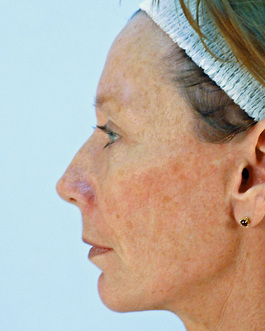 Facial Implants in Virginia Beach
