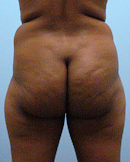 Brazilian Butt Lift Before and After | Dr. Thomas Hubbard