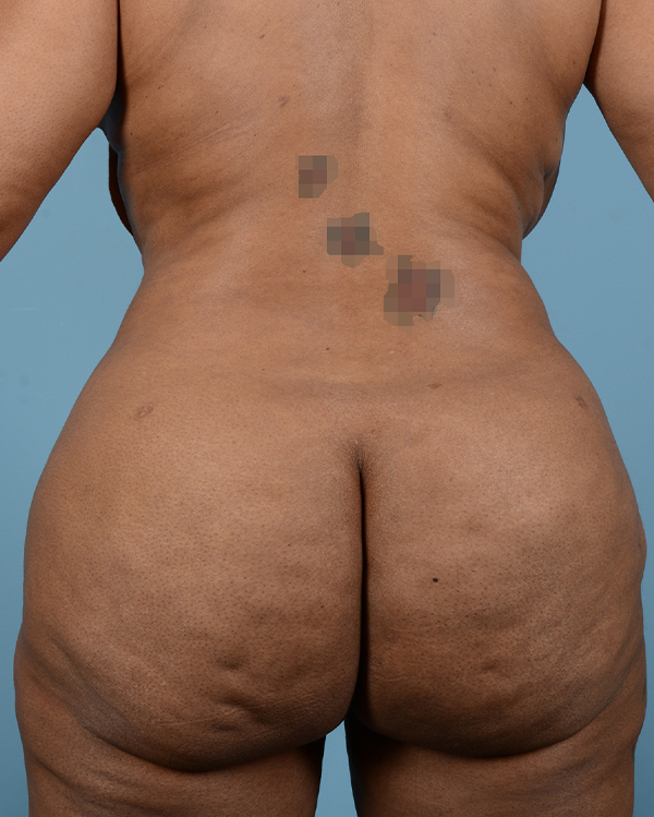 Brazilian Butt Lift Before and After | Dr. Thomas Hubbard