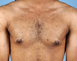 Gynecomastia Before and After | Dr. Thomas Hubbard