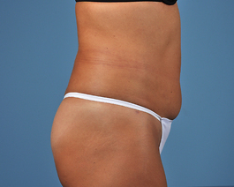 Liposuction Before and After | Dr. Thomas Hubbard