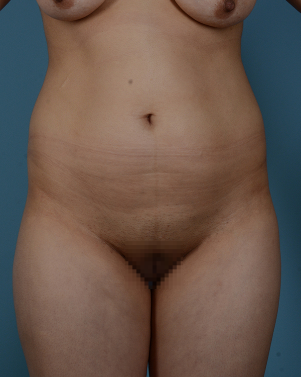 Liposuction Before and After | Dr. Thomas Hubbard