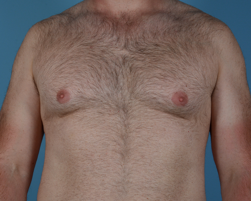 Male Breast Body Before and After | Dr. Thomas Hubbard