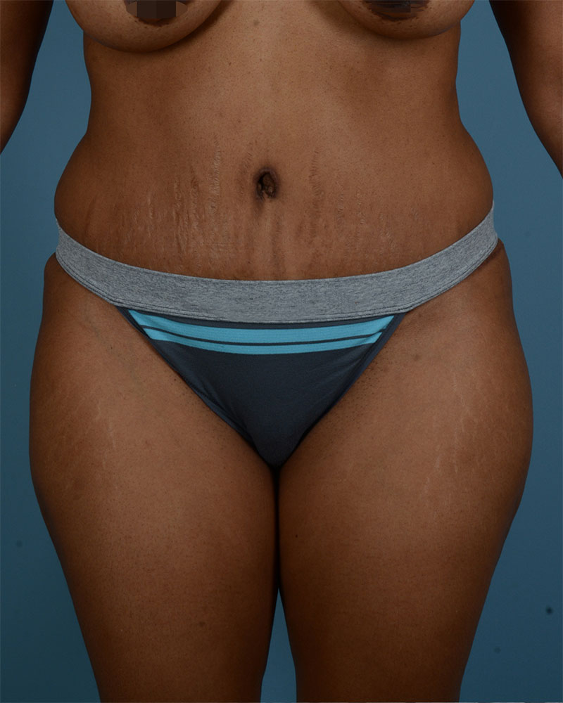 Tummy Tuck Before and After | Dr. Thomas Hubbard