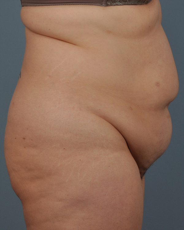 Tummy Tuck Before and After | Dr. Thomas Hubbard