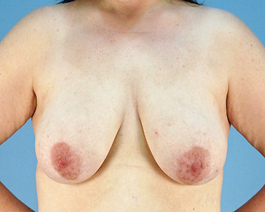 Breast Augmentation With Lift Before and After | Dr. Thomas Hubbard