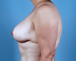 Breast Augmentation With Lift Before and After | Dr. Thomas Hubbard