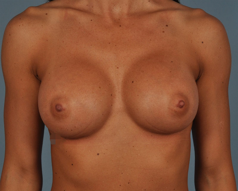 Breast Augmentation Before and After | Dr. Thomas Hubbard
