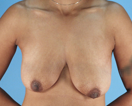 Breast Lift Before and After | Dr. Thomas Hubbard