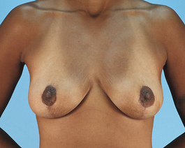 Breast Lift Before and After | Dr. Thomas Hubbard