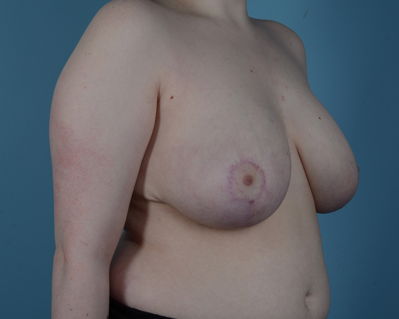 Breast Reduction Before and After | Dr. Thomas Hubbard