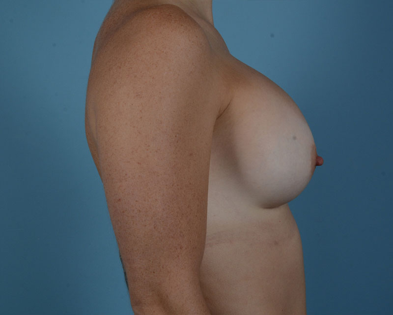 Breast Revision Before and After | Dr. Thomas Hubbard