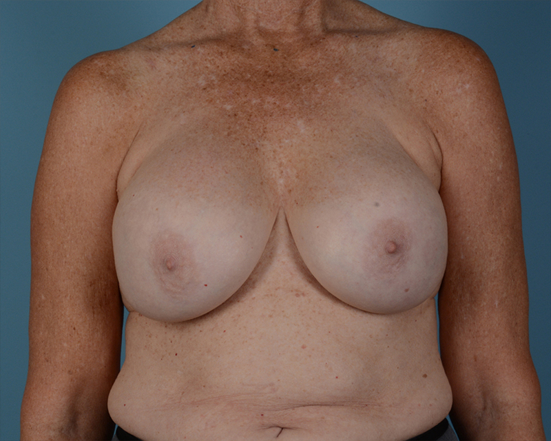 Breast Revision Before and After | Dr. Thomas Hubbard