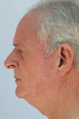 Male Face Procedures Before and After | Dr. Thomas Hubbard