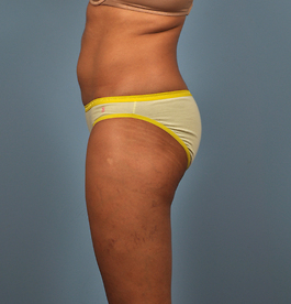 Coolsculpting Before and After | Dr. Thomas Hubbard