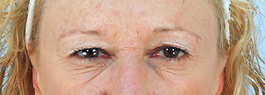 Injectable Wrinkle Reducers Before and After | Dr. Thomas Hubbard
