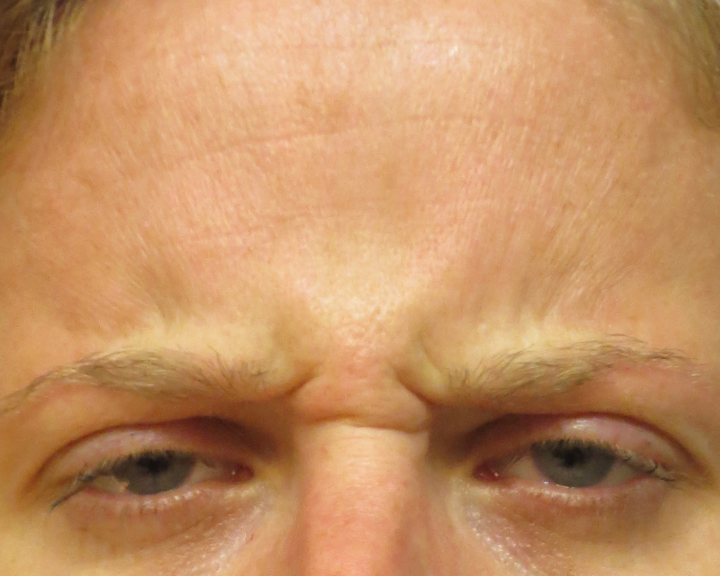 Injectable Wrinkle Reducers Before and After | Dr. Thomas Hubbard