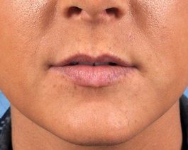 Lip Enlargement in Virginia Beach from Hubbard Plastic Surgery